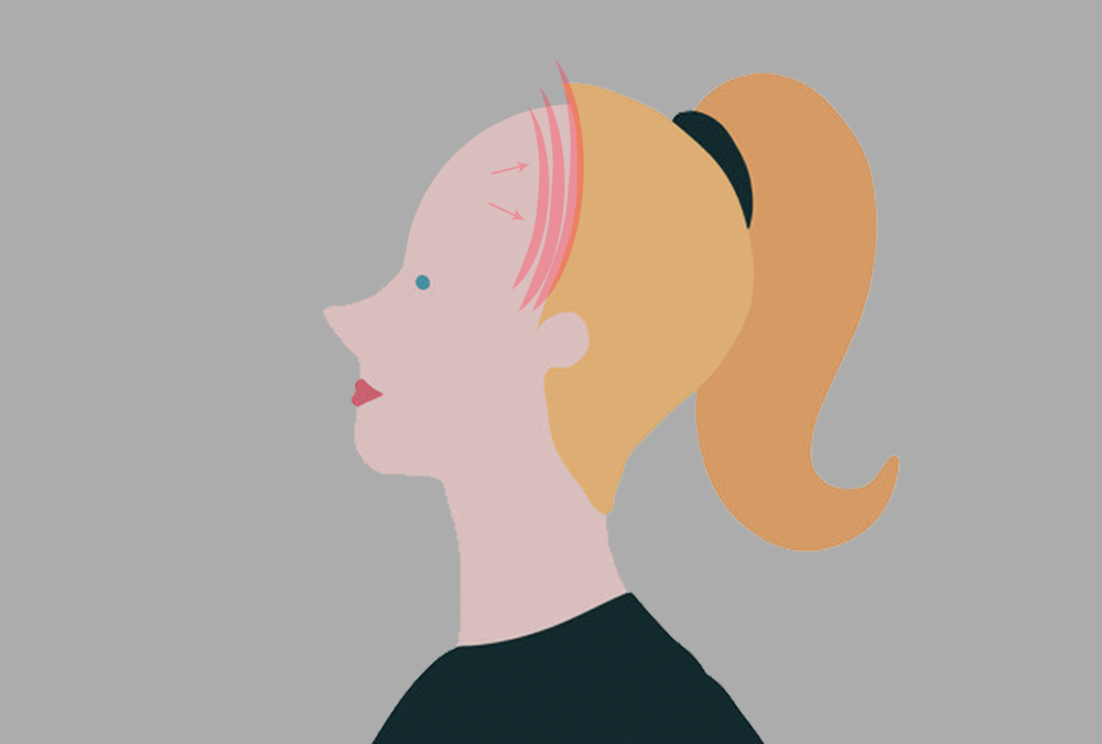 Alopecia frontal fibrosante : O que é?